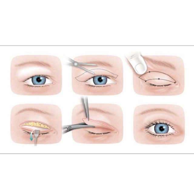 Eyelid Surgery in Turkey