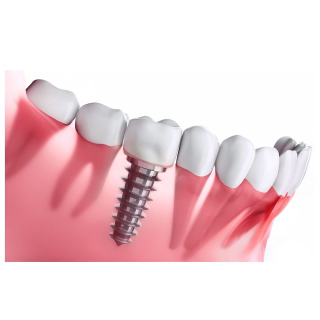 Dental Bridges vs. Dental Implants