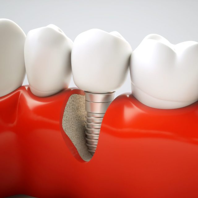 Dental implants