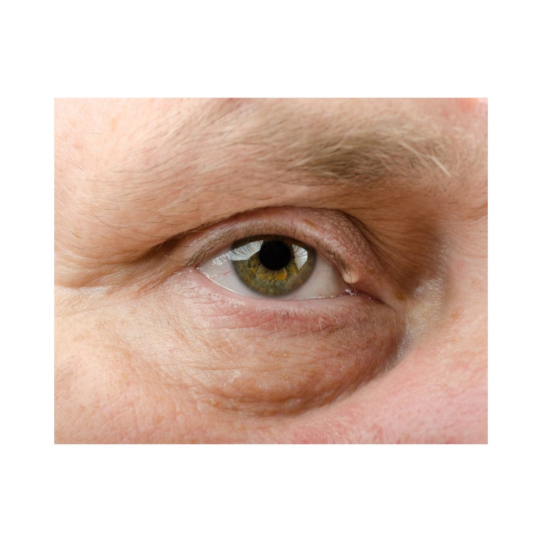 How to reduce ageing around the eyes