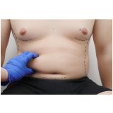 Abdominoplasty Surgery for Men Antalya Turkey