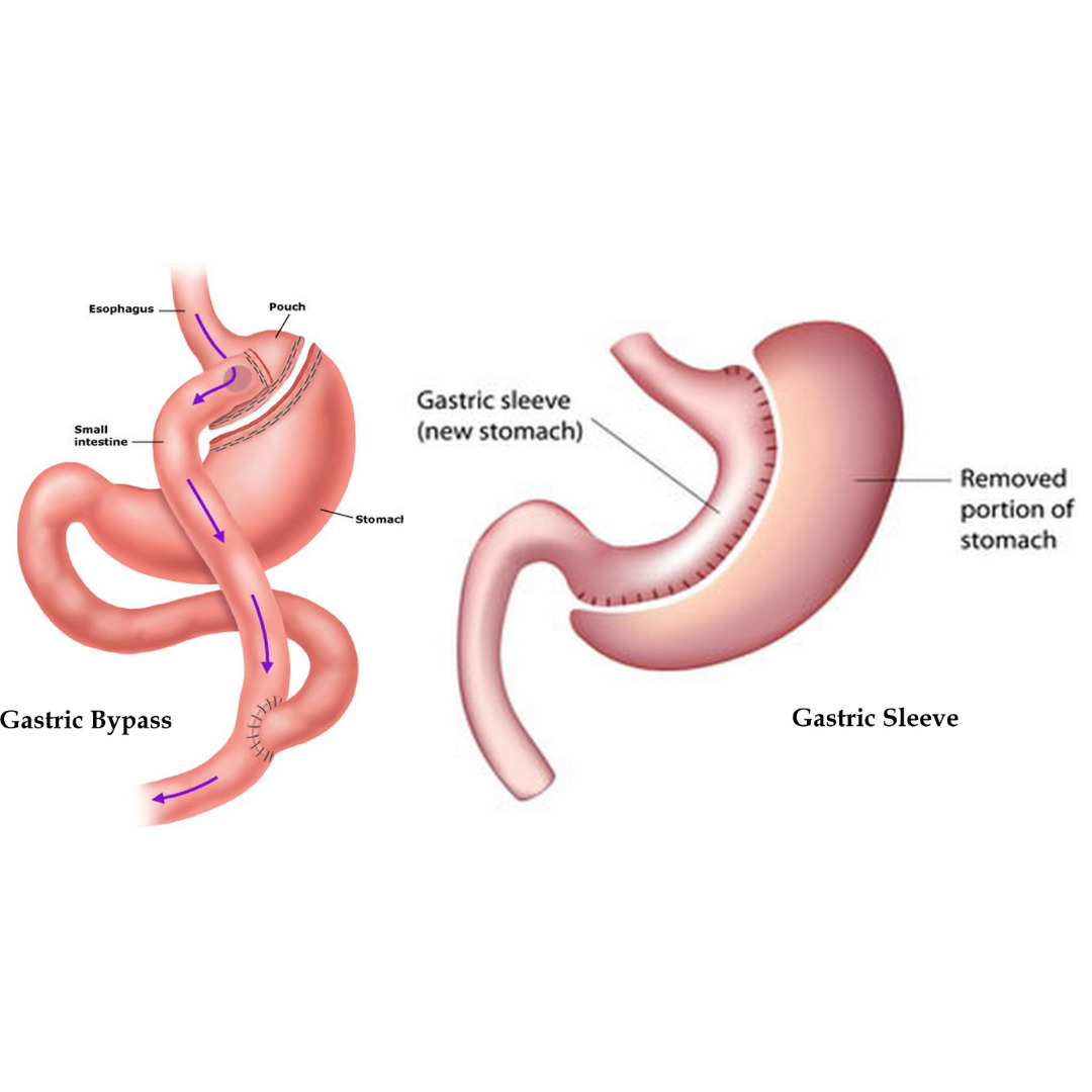 What Are the Differences Between Gastric Bypass and Gastric Sleeve Medgol