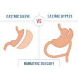 What Are the Differences Between Gastric Bypass and Gastric Sleeve