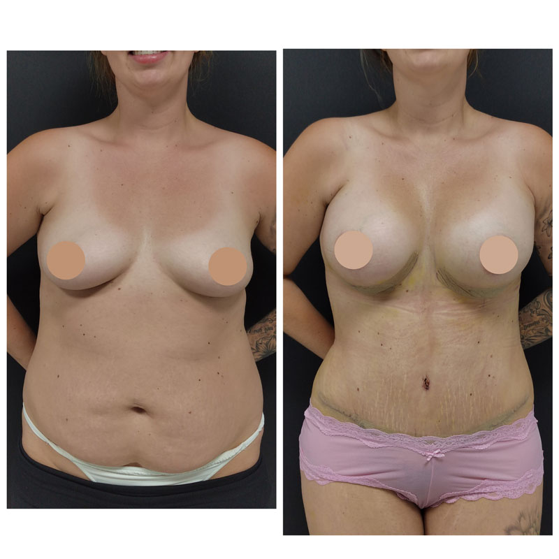 Breast lift in Turkey before and after