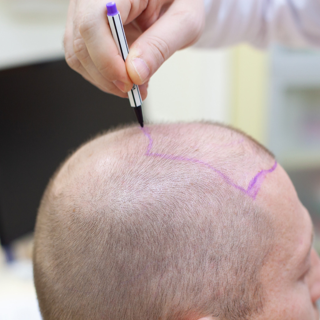 Things to Consider After Hair Transplant