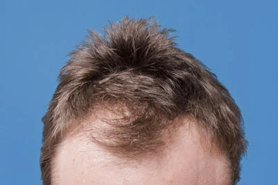 men and hair loss
