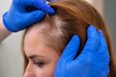 Surgical Hair Restoration for Women