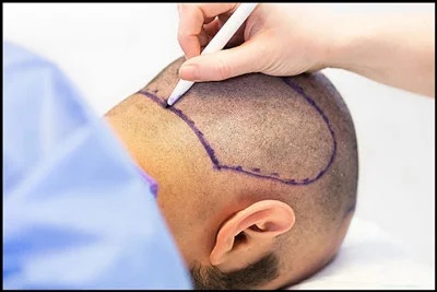 Surgical Hair Restoration