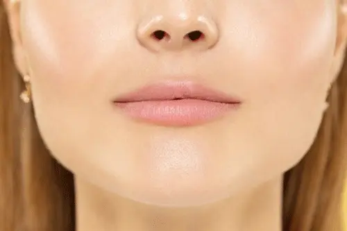 Cheek Augmentation