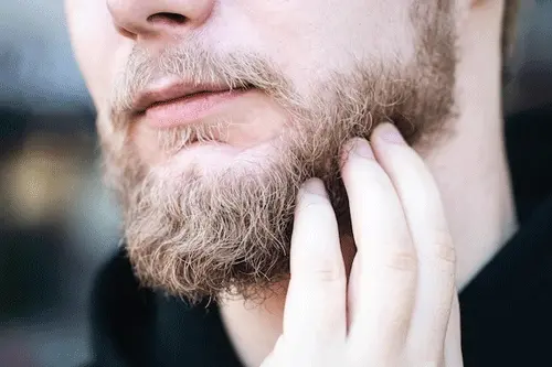 Beard transplant in Antalya
