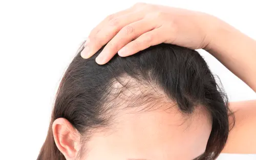 Hair Transplantation For Women in turkey