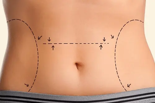Is a tummy tuck safe in antalya
