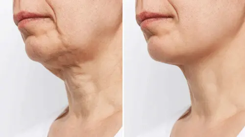 Neck lift in Antalya