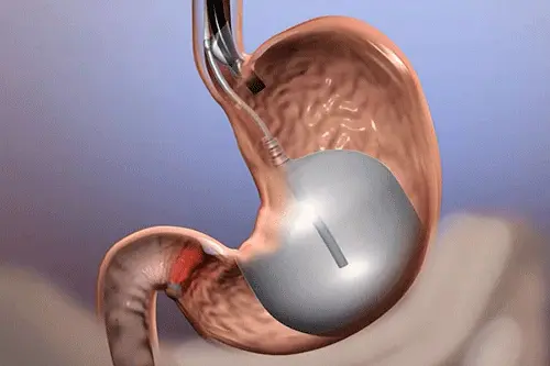 cost of gastric balloon