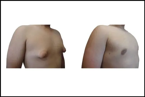 جراحی اصلاح پستان توبروس در آنتالیا
