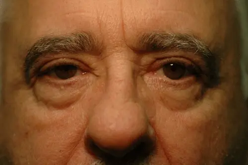 qualify for eyelid surgery in antalya