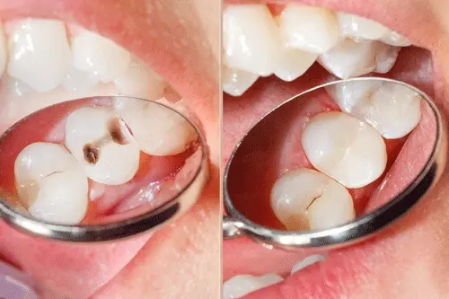 پر کردن دندان در آنتالیا