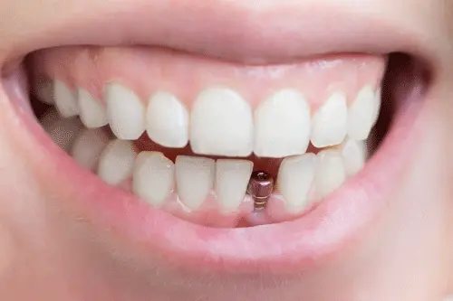 ایمپلنت دندان در ترکیه