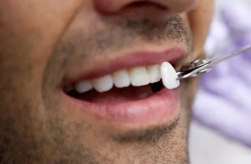 روکش دندان در ترکیه