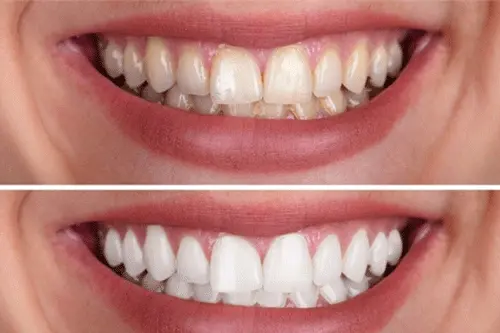 سفید کردن دندان در آنتالیا