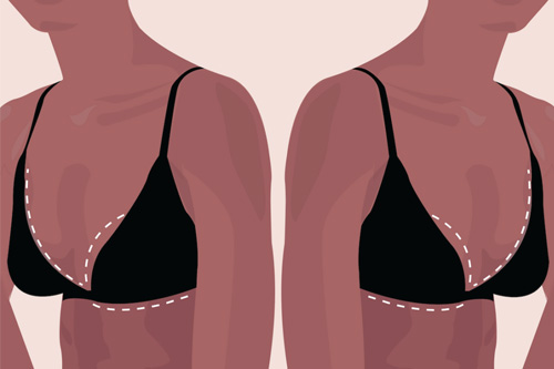 Breast Lift Pros and Cons