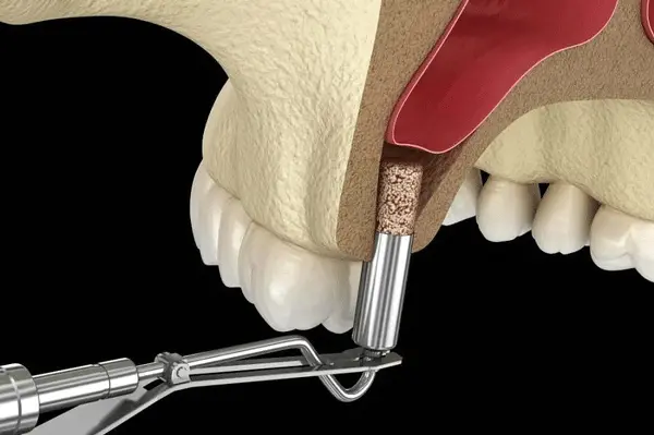 رفع الجيب الأنفي Sinus Lift