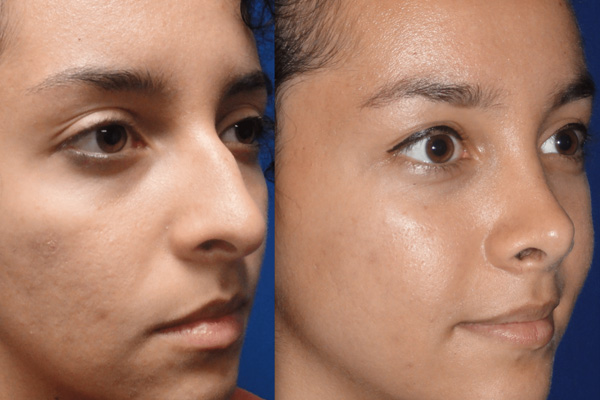 nose surgery in Turkey