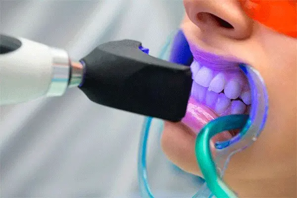 تبييض الأسنان في انطاليا