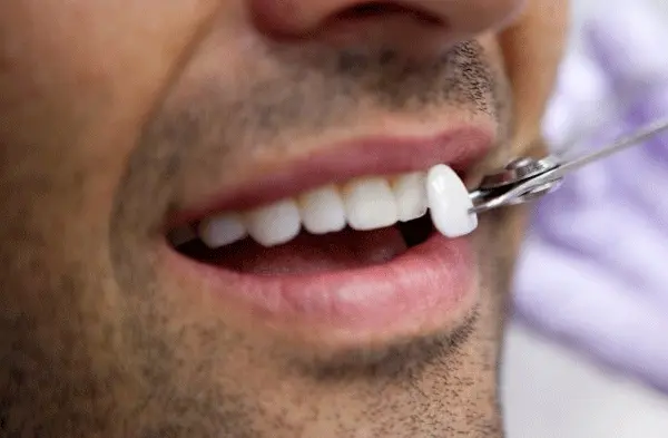قشور الأسنان في ترکیا