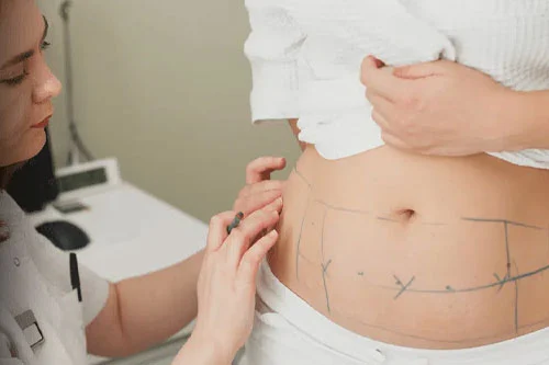 liposuction in Turkey