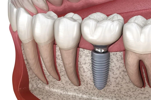 Cost of Dental Implants in Antalya