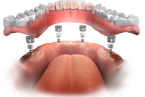 All on 8 Dental Implants Turkey