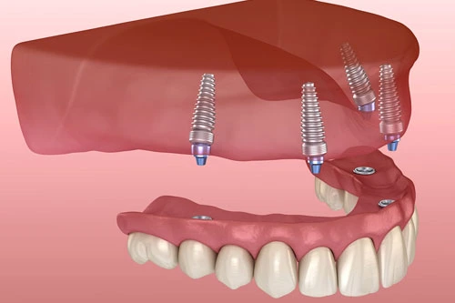 All on 8 Dental Implants Turkey