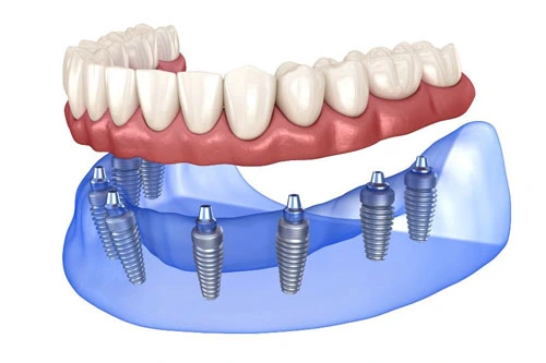 All on 8 Dental Implants Turkey