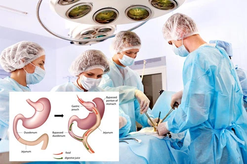 cost of gastric bypass