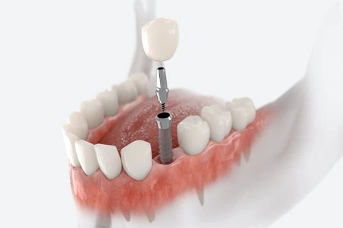 cheapest dental implant