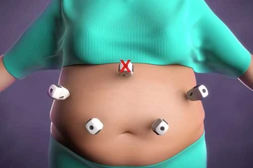 5 Countries for Weight Loss Surgery