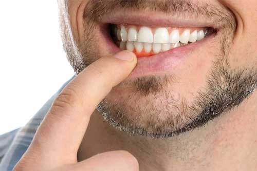 Cost Gum Recession Treatment