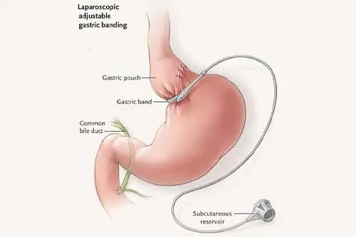 gastric band after care