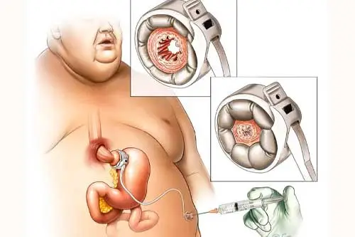 gastric band after care