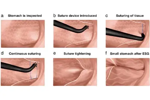  اندوسکوپی معده برای جراحی اسلیو در آنتالیا