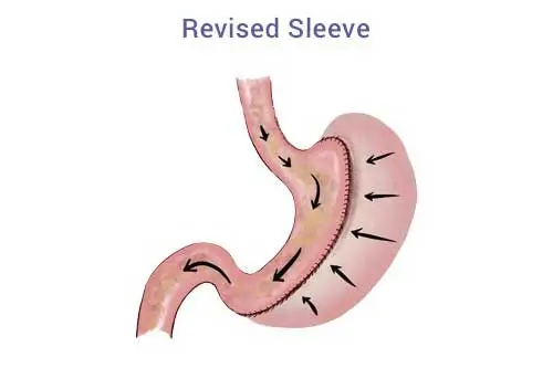 gastric sleeve revision antalya