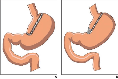 Evolution of bariatric surgery