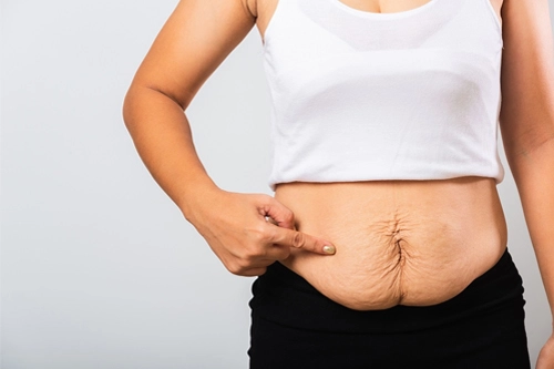 loose skin after gastric sleeve