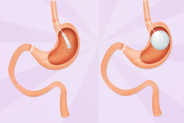 Gastric Balloon Procedure in Turkey