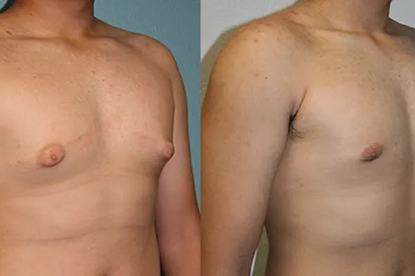 Male Breast Reduction in Antalya, Turkey