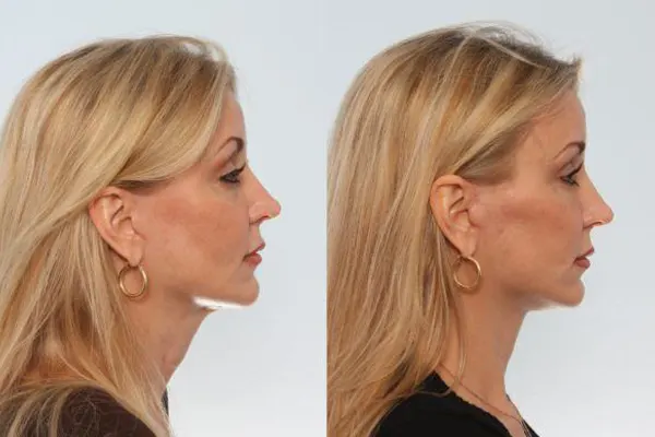 Choosing Antalya for a Safe and Affordable Neck Lift