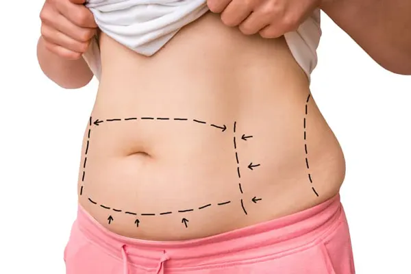 Average Price of a Tummy Tuck in Antalya, Turkey