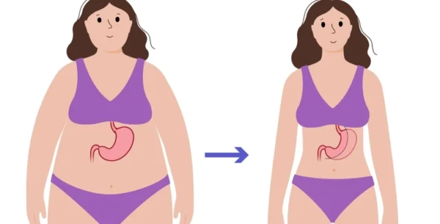 Understanding the Benefits of Gastric Sleeve Surgery