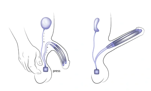 Understanding Penis Enlargement Options